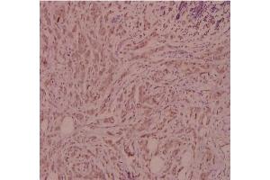 Immunohistochemistry (IHC) analyzes of CD124 / IL4R Antibody in paraffin-embedded human breast carcinoma tissue at 1/100. (IL4 Receptor Antikörper)