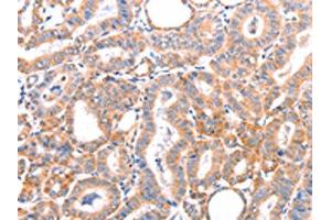 The image on the left is immunohistochemistry of paraffin-embedded Human thyroid cancer tissue using ABIN7128444(AOC1 Antibody) at dilution 1/15, on the right is treated with fusion protein. (DAO Antikörper)