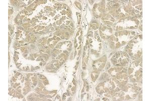 ABIN6266307 and ABIN6277426 at 1/100 staining human renal cell carcinoma by IHC-P. (PIBF1 Antikörper  (C-Term))