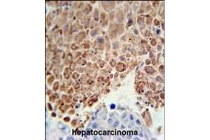 PHGDH Antibody (Center) (ABIN650767 and ABIN2839544) immunohistochemistry analysis in formalin fixed and paraffin embedded human hepatocarcinoma followed by peroxidase conjugation of the secondary antibody and DAB staining. (PHGDH Antikörper  (AA 249-277))