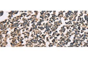 Immunohistochemistry of paraffin-embedded Human tonsil tissue using ZFYVE19 Polyclonal Antibody at dilution of 1:60(x200) (ZFYVE19 Antikörper)