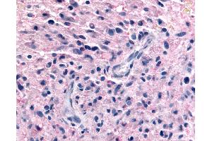 Anti-P2RY12 / P2Y12 antibody IHC of human Brain, Glioblastoma. (P2RY12 Antikörper  (N-Term))