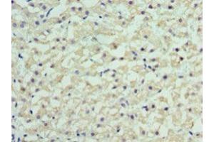 Immunohistochemistry of paraffin-embedded human liver cancer using ABIN7167852 at dilution of 1:100 (RBP4 Antikörper  (AA 19-201))