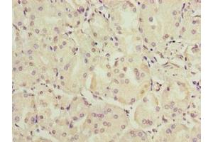Immunohistochemistry of paraffin-embedded human gastric cancer using ABIN7174864 at dilution of 1:100 (C6orf141 Antikörper  (AA 1-237))