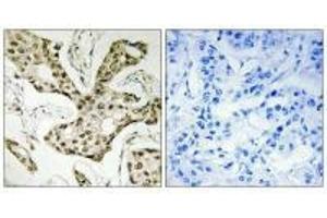 Immunohistochemistry analysis of paraffin-embedded human liver carcinoma tissue using TOP2A antibody. (Topoisomerase II alpha Antikörper  (N-Term))
