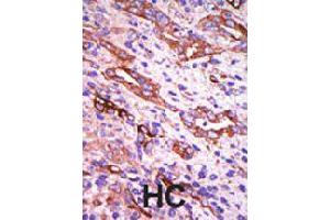 Formalin-fixed and paraffin-embedded human hepatocellular carcinoma tissue reacted with GRK1 polyclonal antibody  , which was peroxidase-conjugated to the secondary antibody, followed by DAB staining . (GRK1 Antikörper  (C-Term))