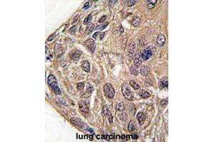 Formalin-fixed and paraffin-embedded human lung carcinomareacted with YARS polyclonal antibody , which was peroxidase-conjugated to the secondary antibody, followed by AEC staining. (YARS Antikörper  (C-Term))