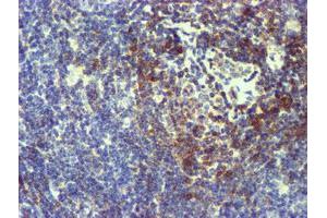 Immunohistochemical staining of paraffin-embedded Human lymphoma tissue using anti-NMT2 mouse monoclonal antibody. (NMT2 Antikörper)
