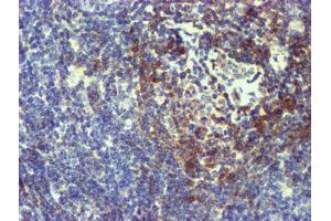 Immunohistochemical staining of paraffin-embedded Human lymphoma tissue using anti-NMT2 mouse monoclonal antibody. (NMT2 Antikörper)
