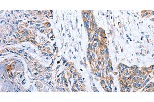 Immunohistochemistry of paraffin-embedded Human esophagus cancer tissue using NDUFA12 Polyclonal Antibody at dilution 1:50 (NDUFA12 Antikörper)