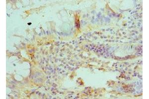 Immunohistochemistry of paraffin-embedded human colon cancer using ABIN7145627 at dilution of 1:100 (BLMH Antikörper  (AA 1-300))