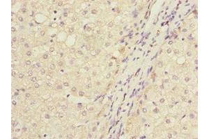 Immunohistochemistry of paraffin-embedded human liver cancer using ABIN7165661 at dilution of 1:100 (IWS1 Antikörper  (AA 570-819))