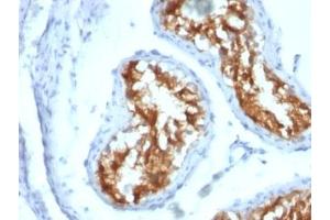 Formalin-fixed, paraffin-embedded human testicular carcinoma stained with Fascin antibody (FSCN1/417) (Fascin Antikörper)