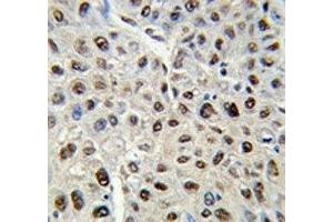 IHC analysis of FFPE human hepatocarcinoma stained with SS-B antibody (SSB Antikörper  (AA 366-397))
