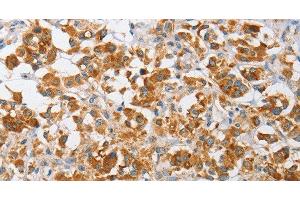 Immunohistochemistry of paraffin-embedded Human thyroid cancer using ARHGEF9 Polyclonal Antibody at dilution of 1:50