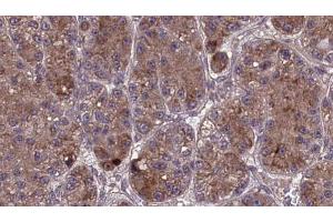 ABIN6273978 at 1/100 staining Human liver cancer tissue by IHC-P. (OR2L3/2L8 Antikörper)