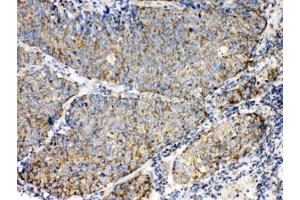 IHC testing of FFPE human lung cancer tissue with TECTA antibody at 1ug/ml.