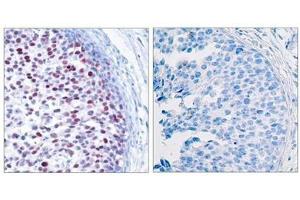 Immunohistochemical analysis of paraffin-embedded human breast carcinoma tissue using c-Jun(Phospho-Thr239) Antibody(left) or the same antibody preincubated with blocking peptide(right). (C-JUN Antikörper  (pThr239))