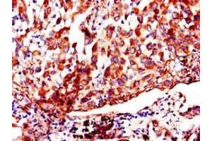 Immunohistochemistry of paraffin-embedded human lung cancer using ABIN7142915 at dilution of 1:100 (AKAP9 Antikörper  (AA 71-191))