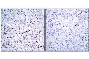 Immunohistochemical analysis of paraffin-embedded human breast carcinoma tissue using c-Jun (phospho- ser63) antibody (E011001). (C-JUN Antikörper  (pSer63))