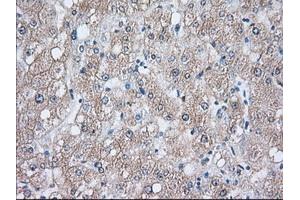 Immunohistochemical staining of paraffin-embedded Human liver tissue using anti-HSPA1A mouse monoclonal antibody. (HSP70 1A Antikörper)