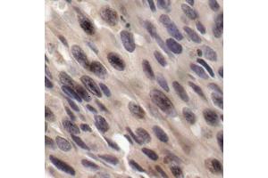 Immunohistochemistry of paraffin-embedded human breast carcinoma, using Phospho-EIF4EBP1-T36 antibody (ABIN2987995). (eIF4EBP1 Antikörper  (pThr36))