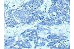 Immunohistochemistry of paraffin-embedded human thyroid cancer (treated with synthetic peptide) using ABIN7190935 at dilution of 1:20 (HES1 Antikörper)