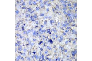 Immunohistochemistry of paraffin-embedded human lung cancer using Casp7 antibody at dilution of 1:100 (400x lens). (Caspase 7 Antikörper)