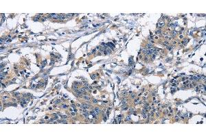 Immunohistochemistry of paraffin-embedded Human gastric cancer using CAPZA2 Polyclonal Antibody at dilution of 1:30 (CAPZA2 Antikörper)