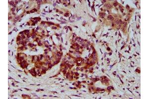 IHC image of ABIN7169579 diluted at 1:400 and staining in paraffin-embedded human pancreatic cancer performed on a Leica BondTM system. (Sialidase 4 Antikörper  (AA 225-377))