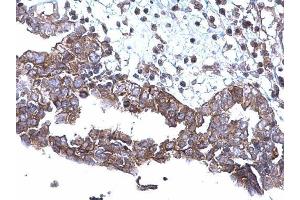 IHC-P Image SQSTM1 antibody [N3C1], Internal detects SQSTM1 protein at cytoplasm on human ovarian carcinoma by immunohistochemical analysis. (SQSTM1 Antikörper)