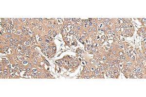 Immunohistochemistry of paraffin-embedded Human prost at e cancer tissue using KRT73 Polyclonal Antibody at dilution of 1:55(x200) (KRT73 Antikörper)