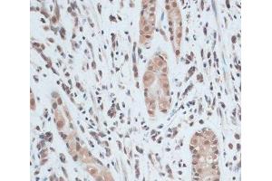 Immunohistochemistry of paraffin-embedded Human gastric cancer using ZNF416 Polyclonal Antibody at dilution of 1:100 (40x lens).