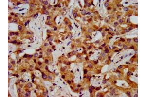 IHC image of ABIN7155063 diluted at 1:200 and staining in paraffin-embedded human liver cancer performed on a Leica BondTM system. (ONECUT1 Antikörper  (AA 192-292))