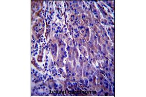CDKN1A Antibody (C-term) (ABIN657391 and ABIN2846432) immunohistochemistry analysis in formalin fixed and paraffin embedded human breast carcinoma followed by peroxidase conjugation of the secondary antibody and DAB staining. (p21 Antikörper  (C-Term))