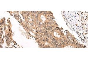 Immunohistochemistry of paraffin-embedded Human colorectal cancer tissue using CHAMP1 Polyclonal Antibody at dilution of 1:40(x200) (ZNF828 Antikörper)