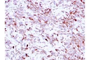 Formalin-fixed, paraffin-embedded human Liver Carcinoma stained with Cathepsin K Mouse Monoclonal Antibody (CTSK/2791). (Cathepsin K Antikörper  (AA 163-274))