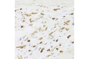 Immunohistochemistry of paraffin-embedded human gastric cancer using LSP1 Antibody (ABIN6130532, ABIN6143368, ABIN6143370 and ABIN6221252) at dilution of 1:100 (40x lens). (LSP1 Antikörper  (AA 1-339))