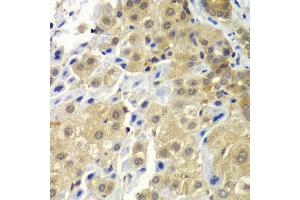 Immunohistochemistry of paraffin-embedded human liver cancer using SGTA antibody at dilution of 1:100 (x40 lens). (SGTA Antikörper)