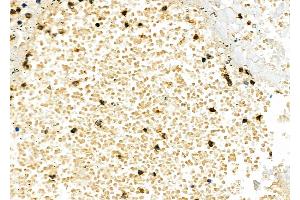 ABIN6262151 and ABIN6277238 at 1/100 staining Human lung cancer and adjacent normal tissues by IHC-P. (TIM3 Antikörper  (C-Term))