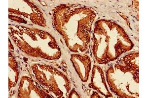 Immunohistochemistry of paraffin-embedded human prostate cancer using ABIN7158066 at dilution of 1:100 (LRRFIP1 Antikörper  (AA 1-315))