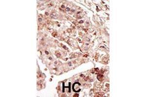 Formalin-fixed and paraffin-embedded human cancer tissue reacted with the primary antibody, which was peroxidase-conjugated to the secondary antibody, followed by DAB staining. (STK31 Antikörper  (C-Term))