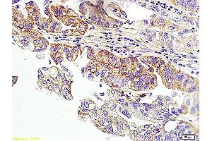 Formalin-fixed and paraffin embedded human ovarian cancer labeled with Anti-HER2 receptor(NT) Polyclonal Antibody, unconjugated (ABIN678068)  at 1: 200 followed by incubation with conjugated secondary antibody and DAB staining (ErbB2/Her2 Antikörper  (AA 151-250))