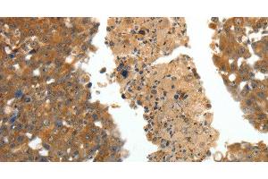 Immunohistochemistry of paraffin-embedded Human breast cancer using CRP Polyclonal Antibody at dilution of 1:80 (CRP Antikörper)