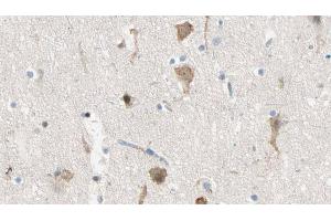 ABIN6274450 at 1/100 staining Human brain cancer tissue by IHC-P. (MADD Antikörper  (Internal Region))