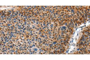 Immunohistochemistry of paraffin-embedded Human liver cancer using AMDHD2 Polyclonal Antibody at dilution of 1:40 (AMDHD2 Antikörper)