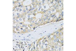 Immunohistochemistry of paraffin-embedded human breast cancer using SLC3A2 antibody (ABIN1876903) at dilution of 1:100 (40x lens). (SLC3A2 Antikörper)