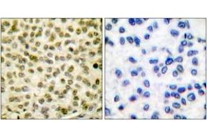 Immunohistochemistry analysis of paraffin-embedded human breast carcinoma, using Myc (Phospho-Ser62) Antibody. (c-MYC Antikörper  (pSer62))