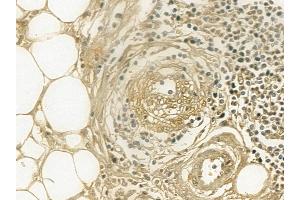 Cytokeratin 2e Mouse Monoclonal Antibody at 1/100 staining human pancreatic cancer and adjacent non-tumor tissue by IHC-P. (Keratin 2 Antikörper  (N-Term))