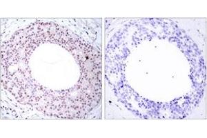 Immunohistochemistry analysis of paraffin-embedded human breast carcinoma, using NF-kappaB p65 (Phospho-Thr254) Antibody. (NF-kB p65 Antikörper  (pThr254))